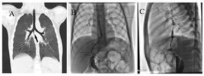 Congenital Bronchobiliary Fistula: A Case Report and Literature Review